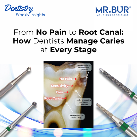 Mr. Bur dental burs used for stage based caries management from early enamel lesions to root canal treatment ensuring precise and conservative removal.