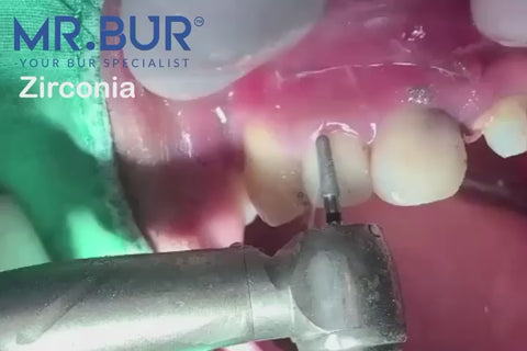Mr. Bur Crown Cutter Hybrid Twister Super Coarse Diamond Bur FG ensures fast, precise crown removal with superior cutting efficiency and durability for optimal dental procedures.